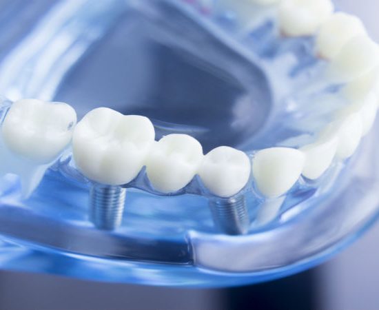 Tips For Recovering From Dental Implants In Fairfield County CT