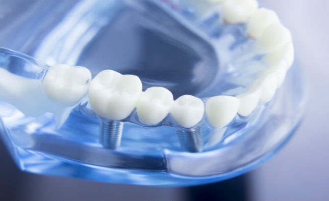 Tips For Recovering From Dental Implants In Fairfield County CT