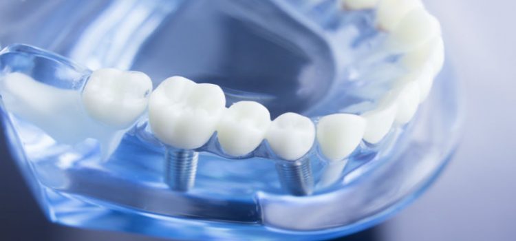 Tips For Recovering From Dental Implants In Fairfield County CT