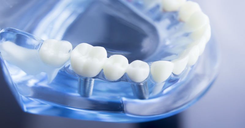 Is All on 4 Dental Implants in Macon, GA the Best Option for You?
