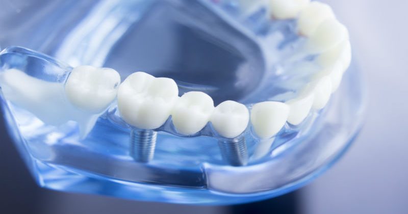 Tips For Recovering From Dental Implants In Fairfield County CT