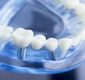 Tips For Recovering From Dental Implants In Fairfield County CT
