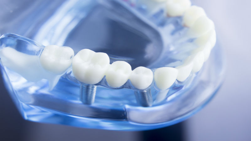 Tips For Recovering From Dental Implants In Fairfield County CT