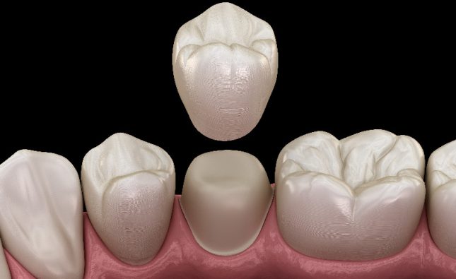 The Right Dental Tech Lab Can Make the Perfect Dental Device to Improve Your Smile