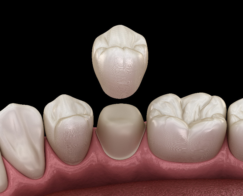 The Right Dental Tech Lab Can Make the Perfect Dental Device to Improve Your Smile