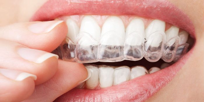 Why Dallas Residents Prefer Dental Implants to Replace Missing Teeth