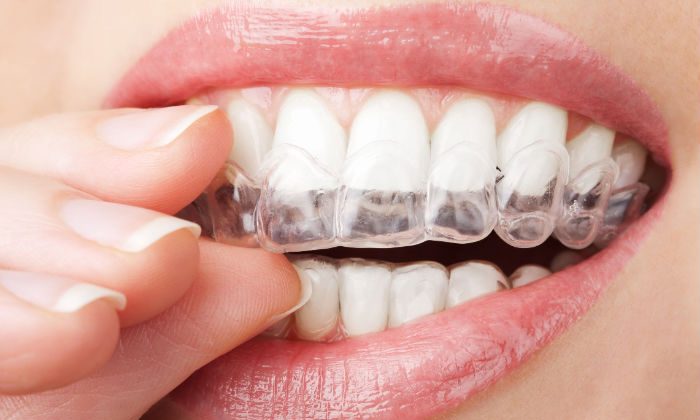 Why Dallas Residents Prefer Dental Implants to Replace Missing Teeth