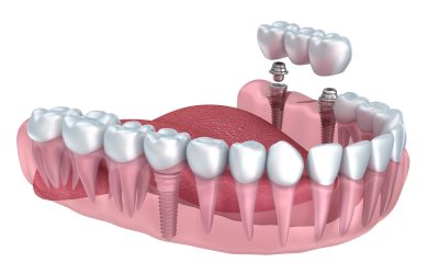 Choosing Dental Implants Chaska, MN, for Lasting Results and Natural Appearance